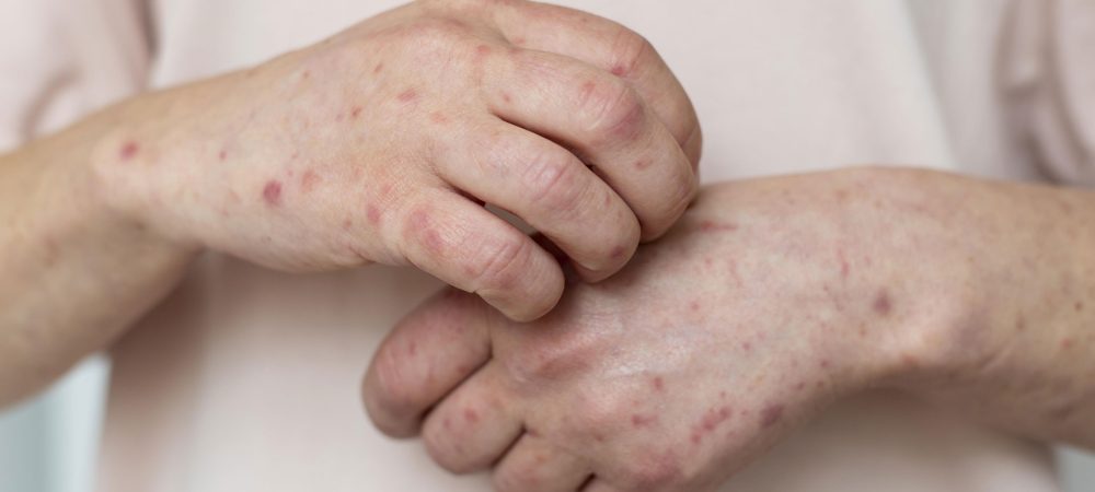 Dermatitis atópica